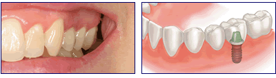 Replacement of a single tooth with a dental implant