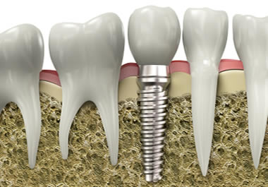Dental Implants